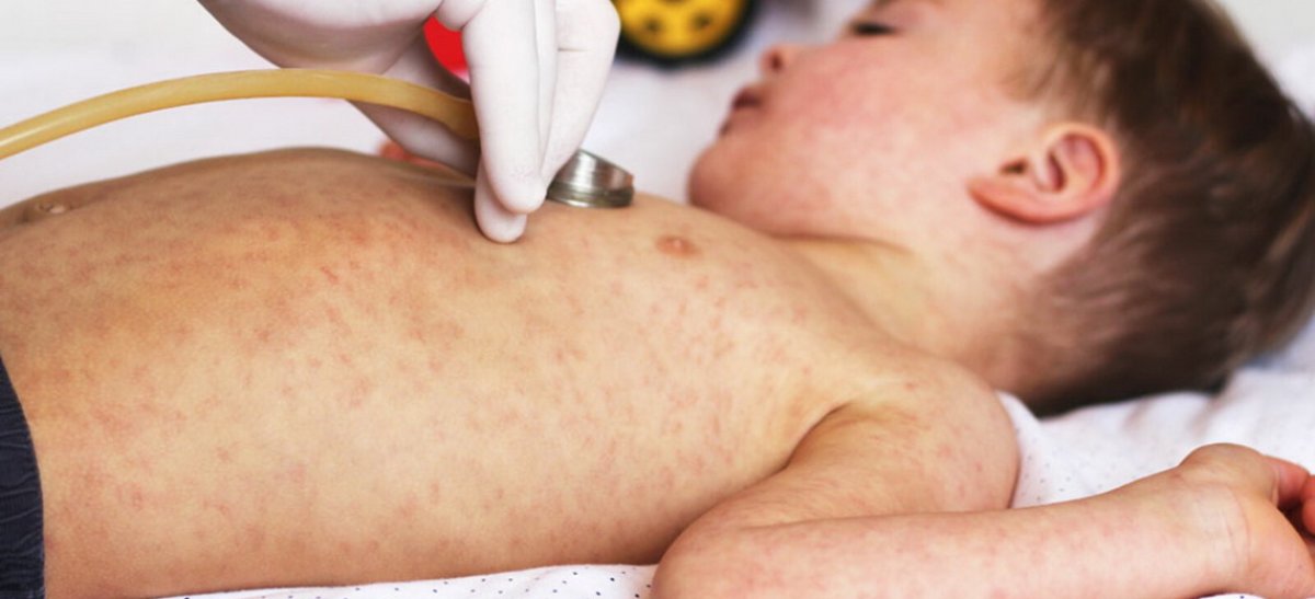 Отказы от прививок разогнали вспышку кори в Казахстане — данные Минздрава