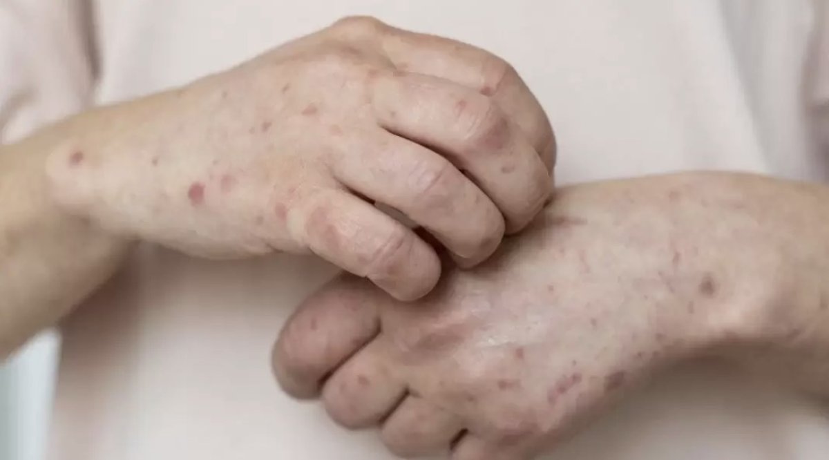 В Казахстане растёт заболеваемость корью: Минздрав усилил меры