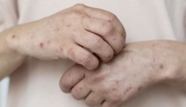 В Казахстане растёт заболеваемость корью: Минздрав усилил меры