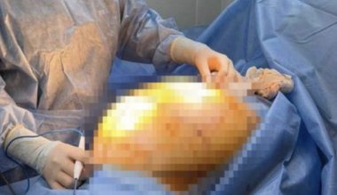 Пыталась вылечить БАДами: у алматинки удалили опухоль весом почти 25 кг
